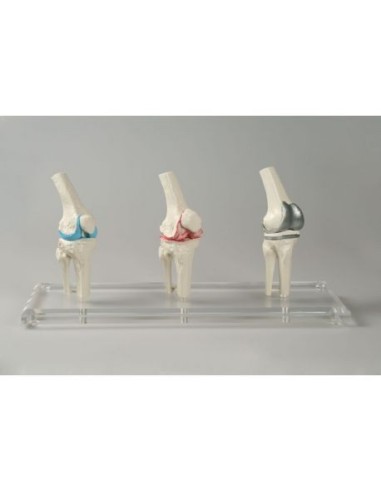 Erler Zimmer, anatomical model of knee joint, with prosthesis 1125