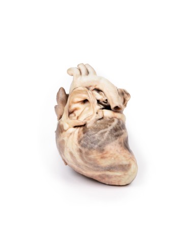 Congenital pulmonary stenosis - Erler Zimmer 3D anatomy Series MP2034