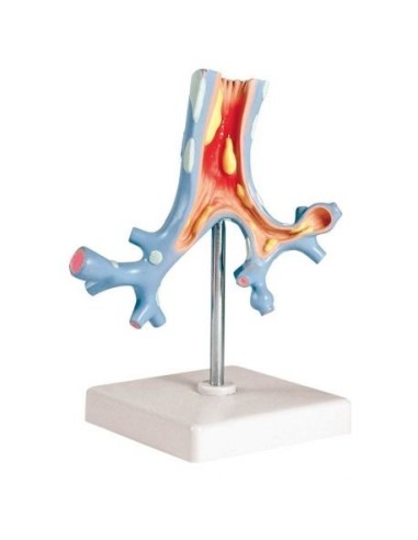 Erler Zimmer, Anatomisches Lehrmodell der Bronchialkrankheiten G151