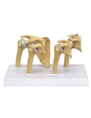 Erler Zimmer, anatomical model of 4 stages of arthritis of the M27 Shoulder