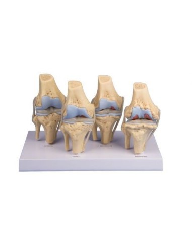 Erler Zimmer, anatomical model of 4 stages of knee arthritis