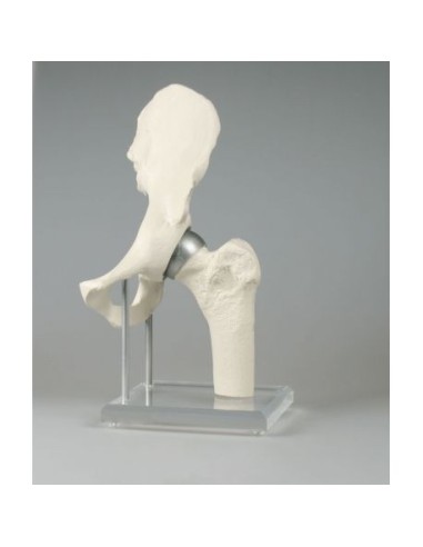 Erler Zimmer, anatomical model of hip joint, with Birmingham 1118 prosthesis