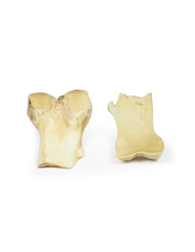 Osteochondrom - Erler Zimmer 3D Anatomie Serie MP2118