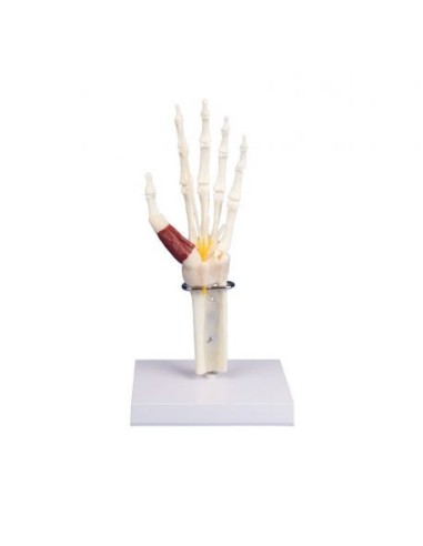 Erler Zimmer, anatomical model of hand and wrist with carpal tunnel syndrome