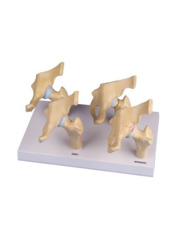 Erler Zimmer, anatomical model of 4 stages of hip arthritis