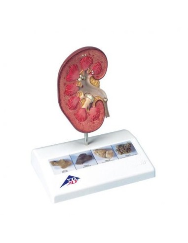 Anatomical model of kidney with kidney stones, 3B Scientific K29