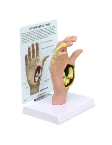 Anatomical model of hand with osteoarthritis 3B Scientific 1019520