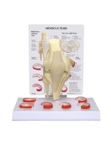 Anatomic model of meniscus with 6 lesions 3B Scientific 1019500