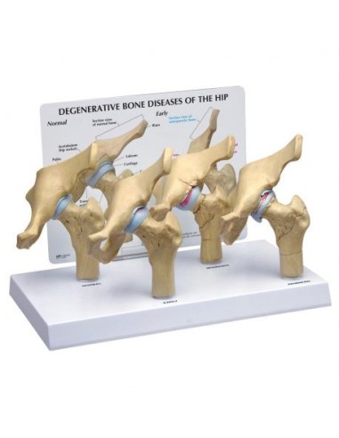 Model of hip joint pathologies 3B Scientific 1019506