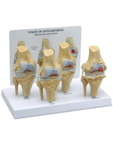 Stages of osteoarthritis of the knee joint (4 stages) 3B Scientific 1019502