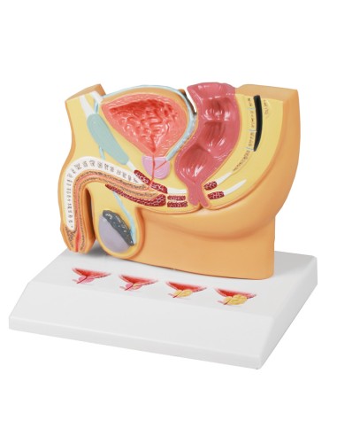 Section of the male pelvis with prostate disease Erler Zimmer H224