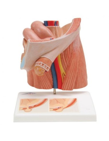 Anatomical model of inguinal hernia, 3B Scientific H13