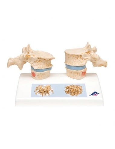 3B Scientific, Osteoporosis Modelo A95