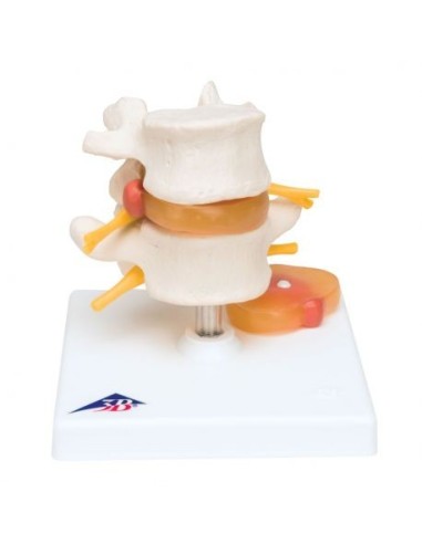 Model of lumbar vertebrae with herniated disc 3B Scientific A76