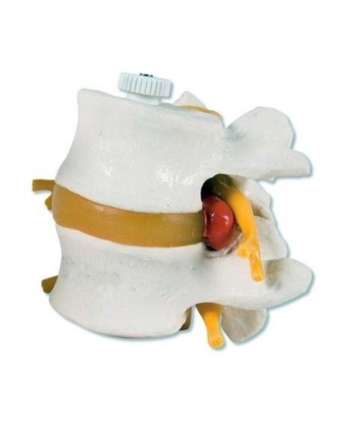 2 lumbar vertebrae with herniated disc 3B Scientific, elastic mounting A76/9