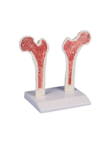 Erler Zimmer, anatomical model of femur with osteoporosis 4030