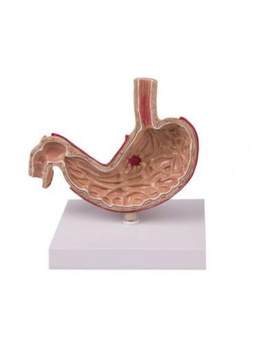 Erler Zimmer, anatomical model of human stomach with K80 pathologies