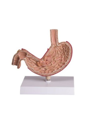 Erler Zimmer, anatomical model of human stomach with cancer K83