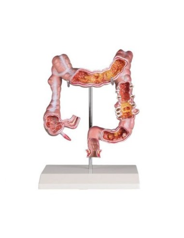 Erler Zimmer, Anatomical teaching model of colon with pathologies K285