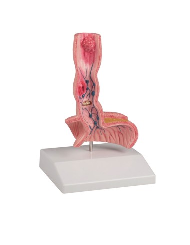 Disease model of the esophagus EZ K218