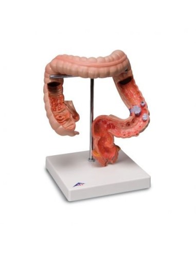 3B Científico, modelo anatómico: Patologías del intestino K55