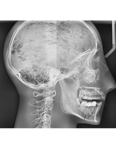 Simulatore per radiologia - Cranio con vertebre cervicali - Trasparente - Erler Zimmer 7300