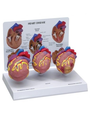 Set educativo, enfermedades del corazón, con tres modelos - 3B Scientific 1019530