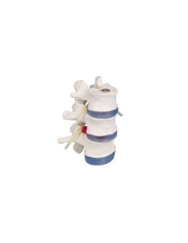 Erler Zimmer anatomical teaching model of 3 lumbar vertebrae with prolapse 4048