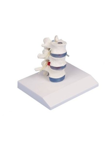 Erler Zimmer anatomical teaching model of 3 lumbar vertebrae with prolapse, on stand 4047