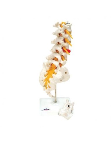 Columna lumbar 3B Científica con hernia discal dorsolateral A76/5