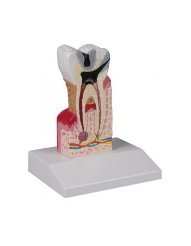 Erler Zimmer, anatomical model of carious tooth, magnified 10-fold D214