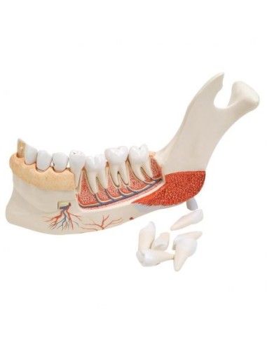 Modelli anatomici 3B scientific, metà della mandibola con 8 denti cariati, in 19 parti VE290