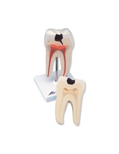 3B Científico, modelo de diente molar inferior de dos raíces, con caries, en dos partes D10/4