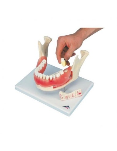 3B Scientific, anatomical model of Dental Pathology, enlarged 2 times, in 21 pieces D26