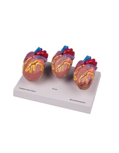 Erler Zimmer, anatomical model of heart disease, decomposable into 6 parts G70