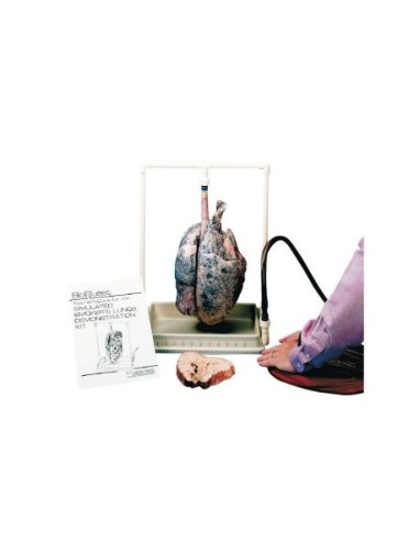 Anatomical model of lungs of an Erler Zimmer smoker, model R10061